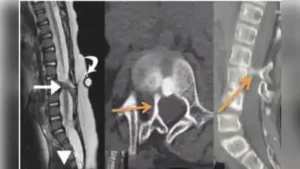 Accidental contact between the drill and the spinal cord, or heat: The wider industry impact