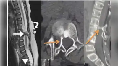 Accidental contact between the drill and the spinal cord, or heat: The wider industry impact