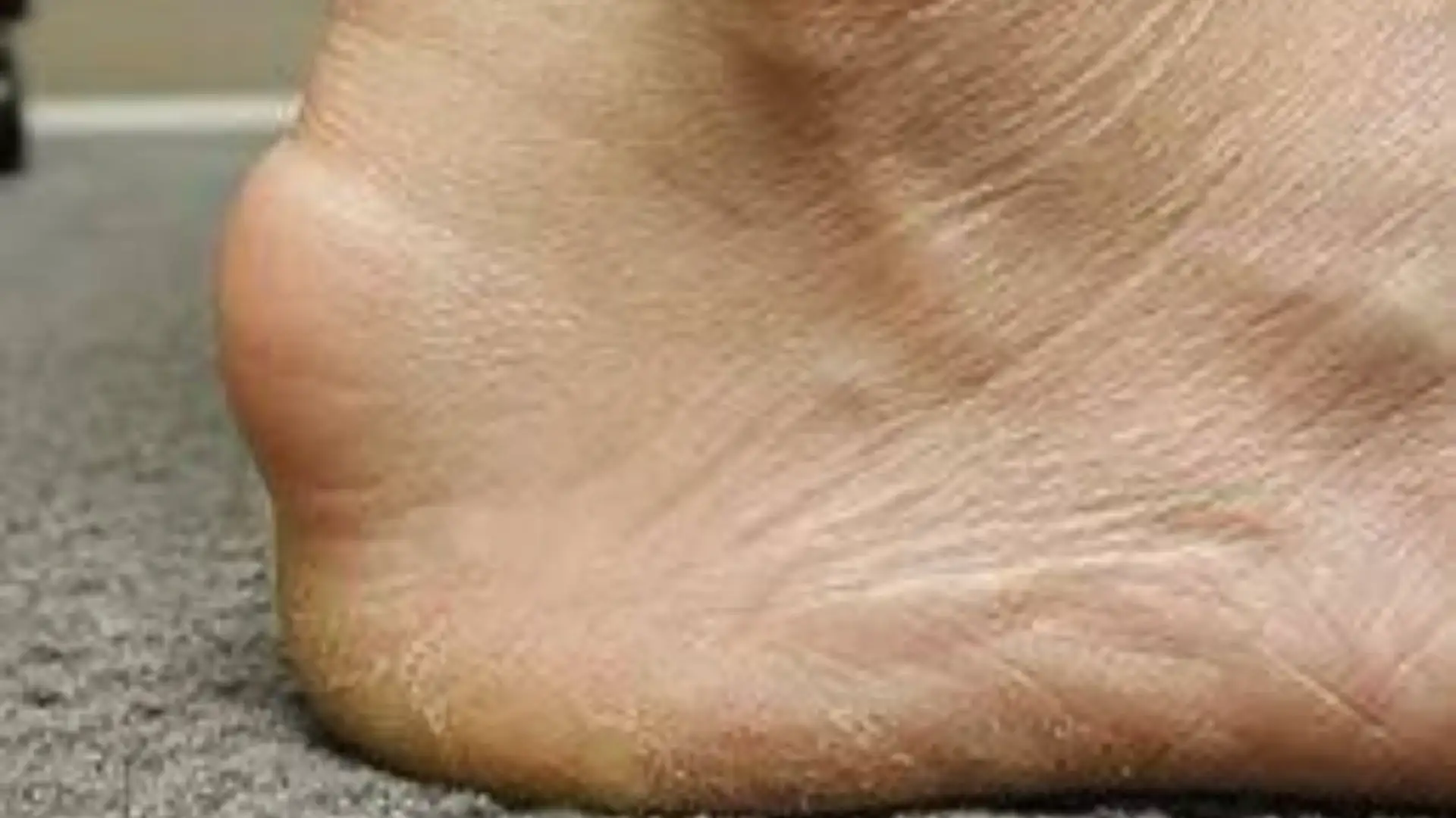 Pedro Neto was seen with a modified football foot