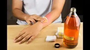 Apple cider vinegar isn't a safe way to remove a mole
