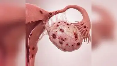 “Endometriosis affects women across the world, but the genetic: The wider industry impact