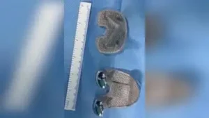 a cementless knee implant, which they said was being performed: The wider industry impact