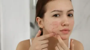 Because of hormonal changes like melasma, pigmentation can show up after acne
