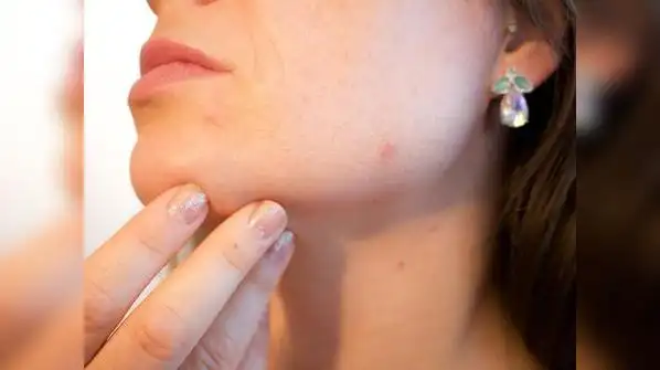 Because of hormonal changes like melasma, pigmentation can show up after acne