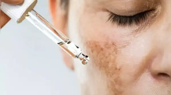 Because of hormonal changes like melasma, pigmentation can show up after acne