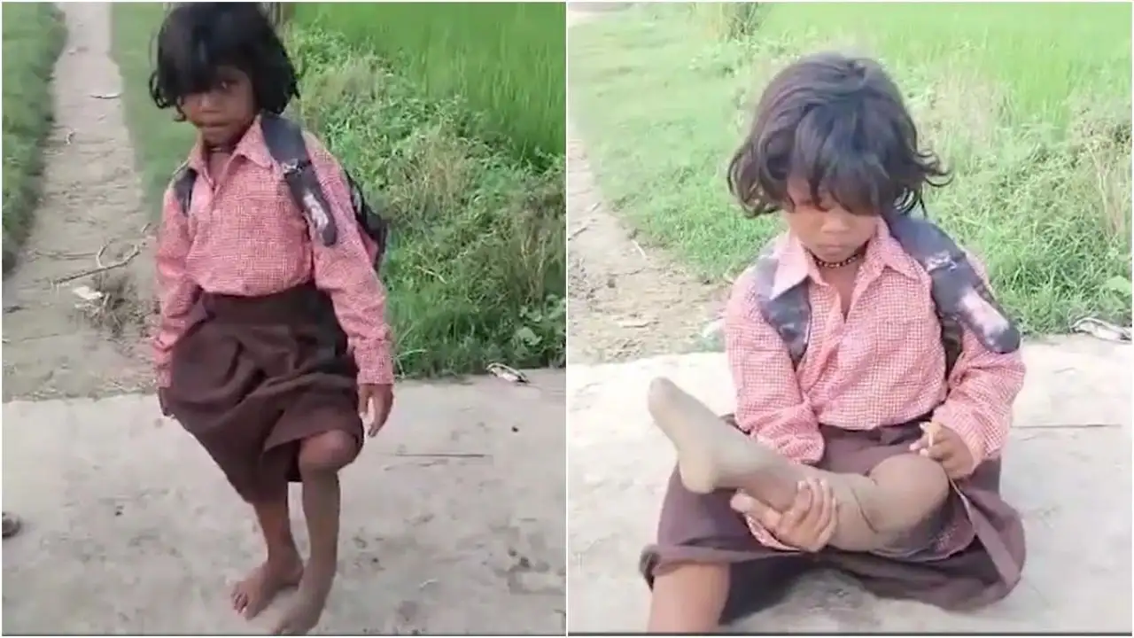 Every single day, Ragini hops nearly 400 meters on her one remaining leg to reach her school