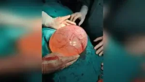 Docs remove 3.5 kg left ovarian cyst successfully: The wider industry impact