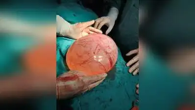 Docs remove 3.5 kg left ovarian cyst successfully: The wider industry impact