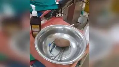 1.5 kg of Stone removed from the rectum of a man in Kanpur