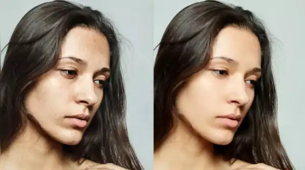 Tanning may affect the forehead, cheeks, arms or hands according to sun exposure, whereas dark