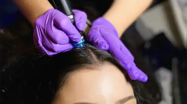 One common question is why someone might need a second hair transplant