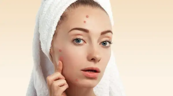 Having to deal with having acne at the age of 30 years is stressful, especially if you see that