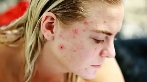 Having to deal with having acne at the age of 30 years is stressful, especially if you see that