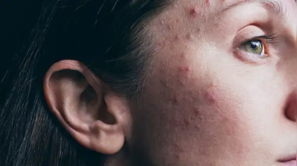 Having to deal with having acne at the age of 30 years is stressful, especially if you see that