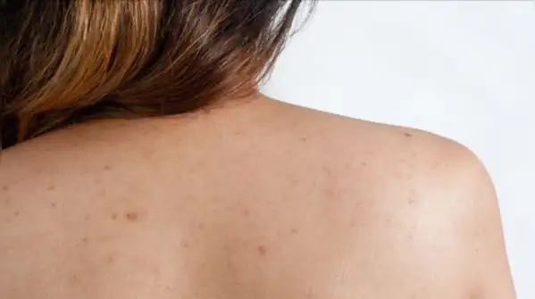 Back acne is very manageable, though, once the cause is clear