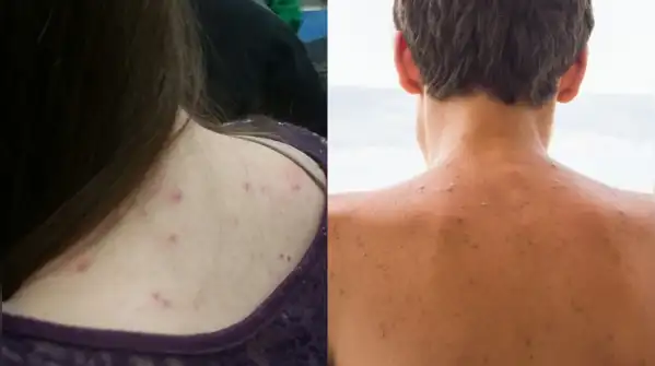 Back acne is very manageable, though, once the cause is clear