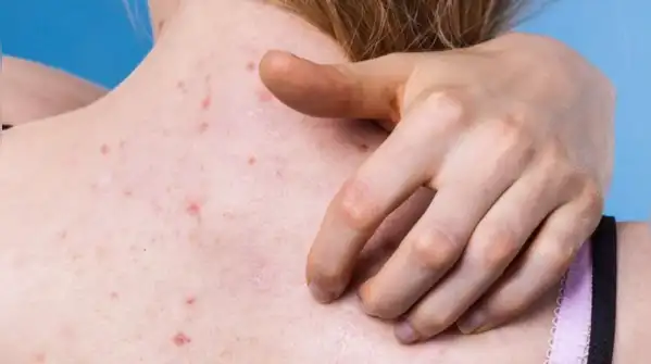 Back acne is very manageable, though, once the cause is clear